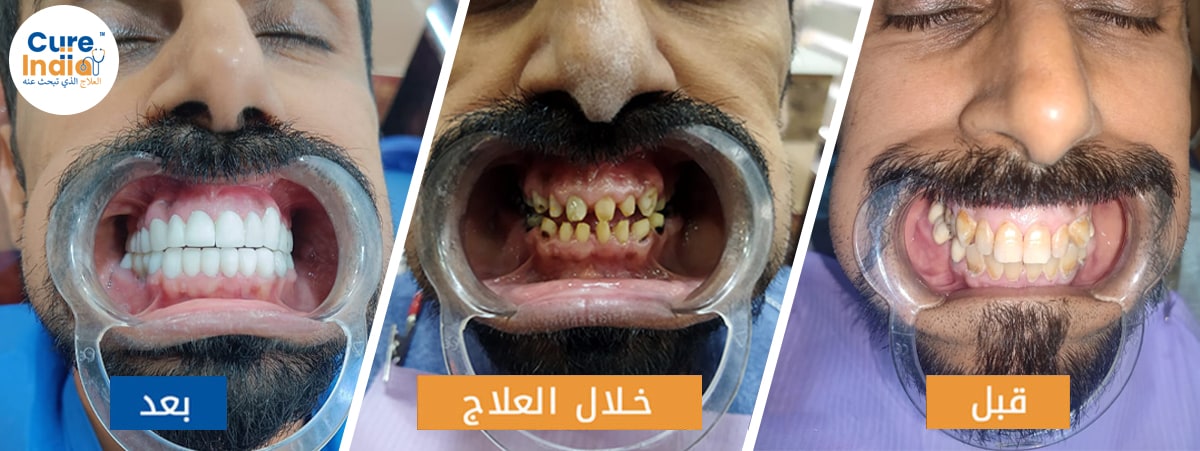 الاخ علي من الكويت - تجربتي مع زراعة الأسنان
